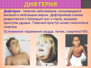 дифтерия